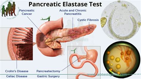 elastaza pancreatica in materii fecale|Fecal elastase, an assay for exocrine pancreatic insufficiency, has ...